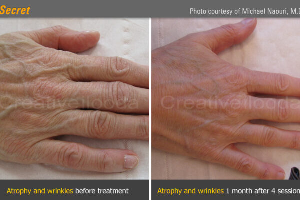06. Atrophy and wrinkles